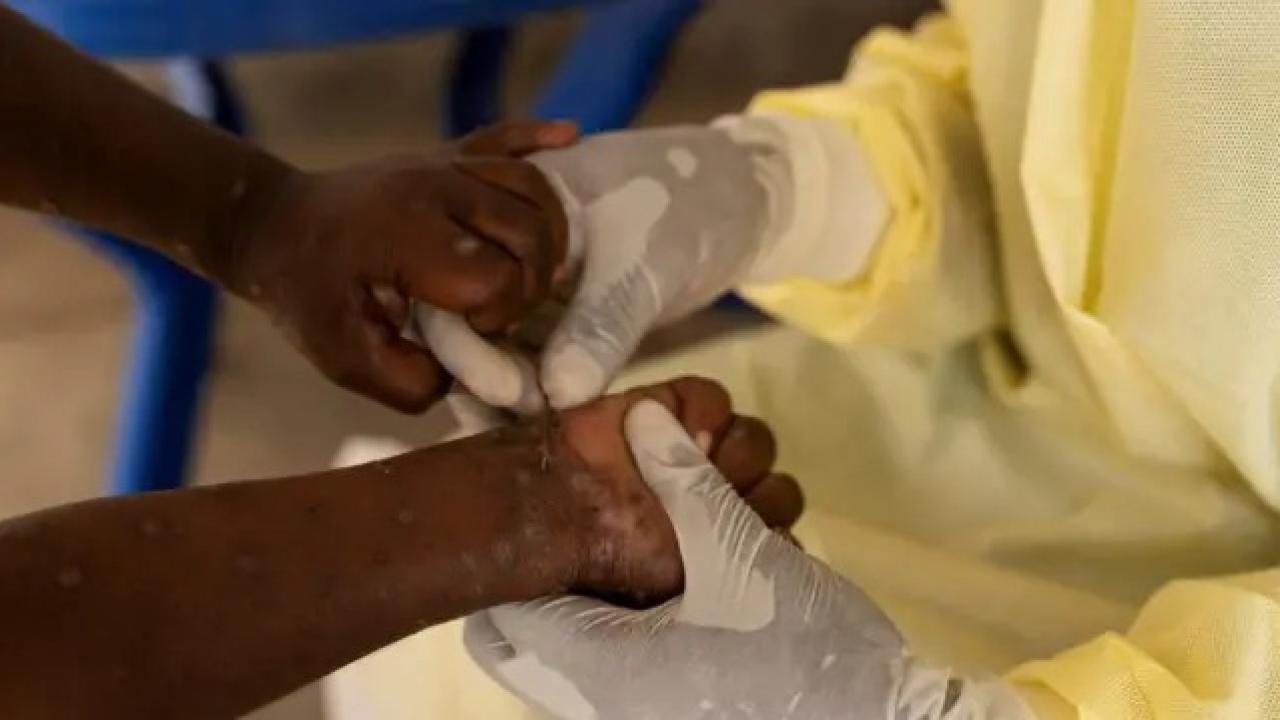 Güney Afrika’da son 5 haftada 13 kişide M çiçeği vakası kaydedildi